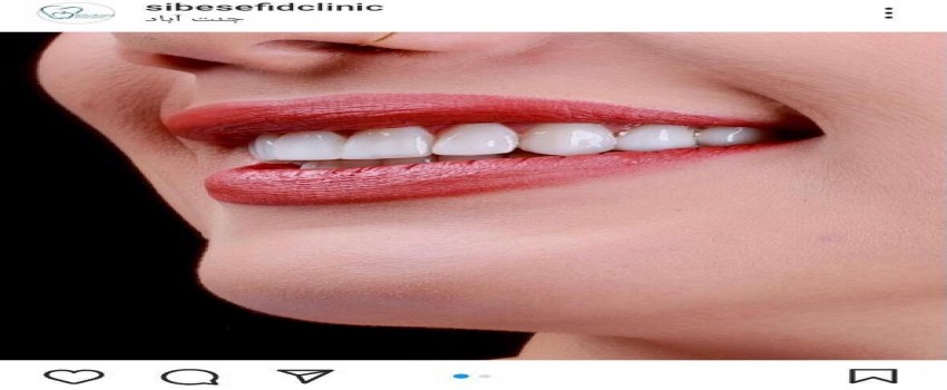 فناوری های جدید برای بهبود کامپوزیت یا لمینت دندان(مقاله اول)